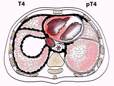 pericardium pericardial effusion with positive cytology invasion of myocardium invasion of brachial plexus pathological tumour