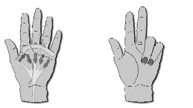 1. Wat is Dupuytren? Dupuytren is een aandoening van het peesblad van bindweefsel in de hand (ook wel de fascia genoemd).