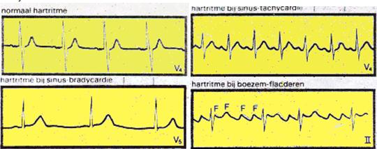 Het ECG kan geanalyseerd worden aan de hand van de volgende eigenschappen: - IJk en papiersnelheid (zie hierboven) - Ritme (sinusritme, ectopisch ritme, sinusarest) - Frequentie - Geleiding: AV