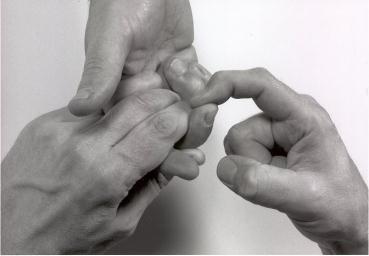 Klinische aspecten: Onderzoek Sensibiliteit -Test de tastzin door te strijken langs de ulnaire en radiale zijde van de verwonde vinger.