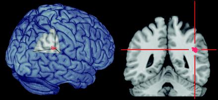 Fmri experiment bij een patiënt met extinctie - y as: signaalveranderingen - x as: seconden na verschijning bepaalde stimulus - lijnen: profiel van persoon met extinctie bij de verschillende visuele