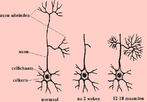 Alzheimer?