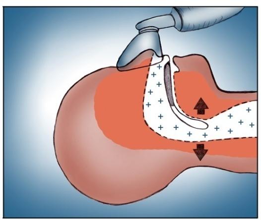 (Afbeelding 4) De overdruk duwt het zachte weefsel en spieren aan de kant. Afb. 4: Overzicht van een ademstilstand en behandeling van CPAP tijdens de nacht.