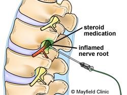 Dexamethasone steroid injection