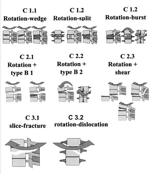 Figuur 5.: Type C (rotatie) letsels. Anterieur en posterieur element letsel met rotatie.