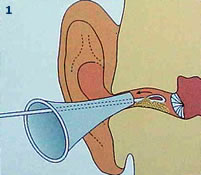 Met behulp van een oortrechtertje en een cerumenlisje (afbeelding 1) of een zuigertje (afbeelding 2) wordt het oorsmeer voorzichtig naar buiten gewerkt.