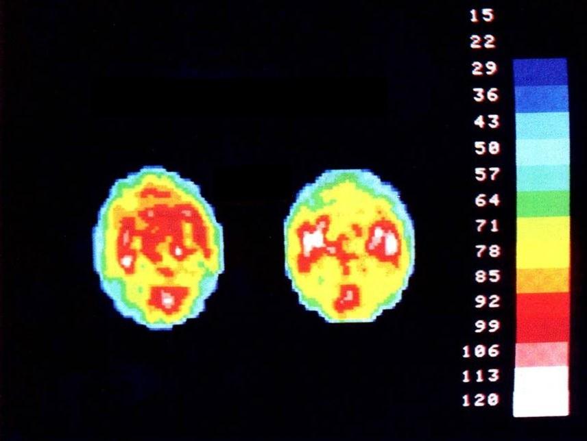 AETIOLOGY Neurophysiology - blood flow SPECT Normal ADHD