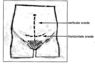 De keizersnede Een keizersnede is een operatie waarbij de baby wordt geboren via een snede in de onderbuik en de baarmoeder.