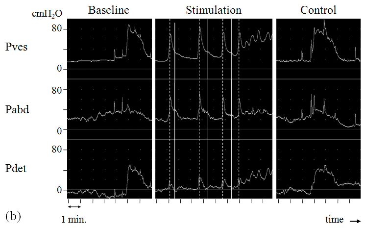 Minimal invasive electrode implantation for conditional stimulation of the DGN in NDO Figure 2. Examples of stimulation effect.