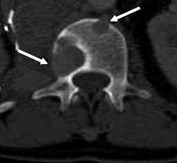 Osteoclasten zijn volop aanwezig in zowel osteolytische als osteoblastische lesies in prostaatkanker Osteolytische lesies 1,3 Osteoblastische lesies 2,4 PC Zwarte pijlen wijzen naar