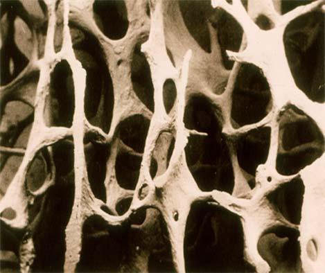 Het continuüm van het skelet normaal osteoporose Bij volwassenen