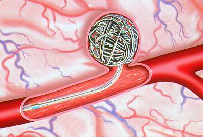 Wat is een coiling? Bij een coiling wordt de binnenkant van het aneurysma opgevuld met dunne platina draadjes (coils) van verschillende afmetingen.