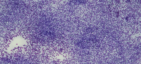 M. Veselic Granulomatous lymphadenitis with necrosis Granulomas with epitheloid histiocyte Giant cells Necrosis Inflammatory cells Ziehl-Nielson staining or auramine staining Material can be obtained