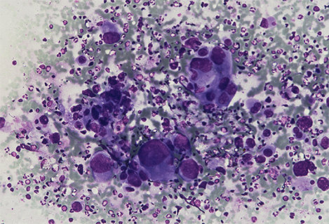 M. Veselic Large cell carcinoma Cellular pattern: Syncytial groups and isolated cells Cell-shape: pleomorphic