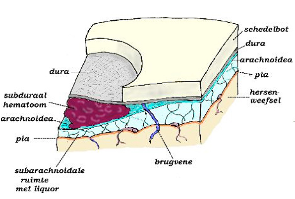 schedelbot dura arachnoidea dura pia subduraal hematoom arachnoidea hersenweefsel pia subarachnoidale ruimte met liquor brugvene Figuur 2 Schematische voorstelling van een chronisch subduraal