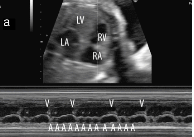 Atrial ectopic tachycardia Atriale ectope tachycardie : postnatale aanpak Adenosine als diagnosticum Atrial ectopic tachycardia Atriale ectope tachycardie :