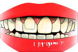 Kronen en bruggen Kronen en bruggen. Duurzame vervangingen voor tanden en kiezen Kronen en bruggen zijn bedoeld als duurzame vervangingen voor tanden en kiezen.
