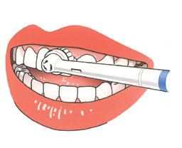 Vastzetten Bij de laatste afspraak past uw tandarts de kroon of brug in uw mond en zet hem vast. Aan de binnenzijde van de kroon of brug brengt hij een snelhardend cement aan.