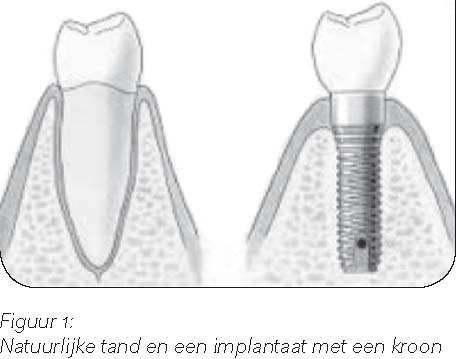 Implantaten Wat is een implantaat Wanneer komt u in aanmerking voor implantaten? Eén of twee behandelingen?