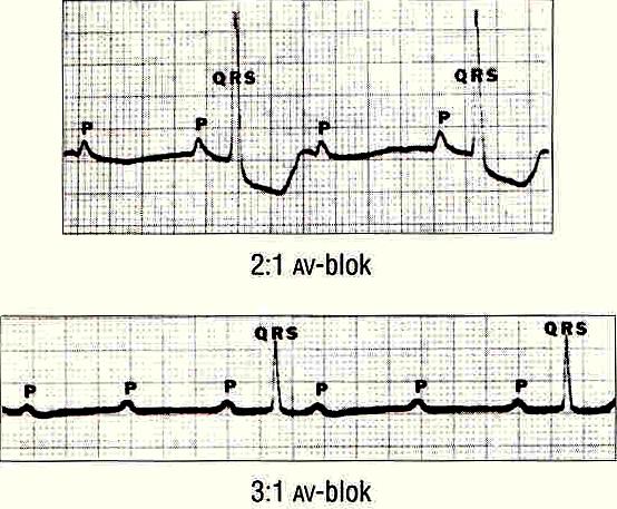 QRS-complex!