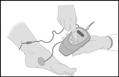 Pagina 5 Nieuw bij Pelvica Bekkenfysiotherapie PTNS bij de overactieve blaas Wat is een overactieve blaas? Heeft u last van extreem vaak moeten plassen, of veelvuldig aandrang gevoel?