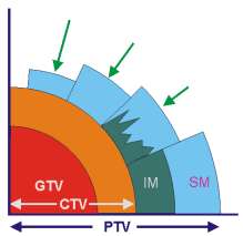 Basisprincipe Radiotherapie GTV: gross tumor volume CTV: clinical target volume ITV: internal target volume: CTV + IM IM: internal