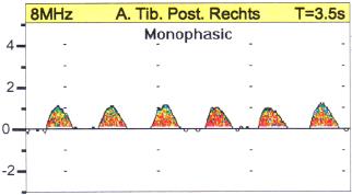 te luisteren: Monofasisch (verdenking stenose!