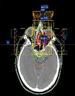 CONFORMAL RADIOTHERAPY Radiotherapie voor HHK Technologie Van 3D-CRT IMRT (intensiteitsgemoduleerde RT) LINEAIR ACCELERATOR COLLIMATOR DIFFERENT BEAM ANGLES MULTI-LEAF COLLIMATOR Technologische