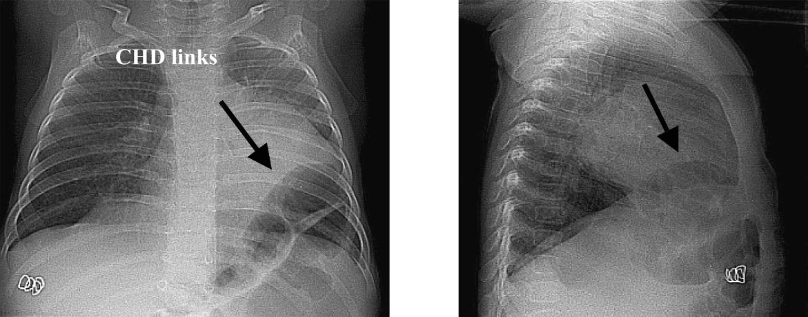 Toevallige bevinding van congenitale hernia diaphragmatica (CHD) bij een patiëntje met bronchiolitis 805 Fig.