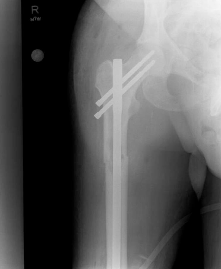 25 Pathologische fractuur Veroorzaakt door destructieve werking van uitgezaaide cellen of botlaesies Tekenen en symptomen Pijn Zwakte Verstoorde gang / manier van lopen Kan traag genezen en