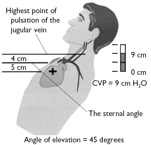 Figuur 1: Benadering CVD Een blik op de druk-volume curve leert ons in principe welke druk een bepaald volume zal genereren (Figuur 2).