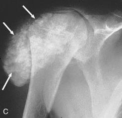 kalk en botten (CKD-MBD) CNS: laag vitamine D hyperfosfatemie hypo- en hypercalciemie secundaire hyperparathyreoidie gevolgen: botziekte