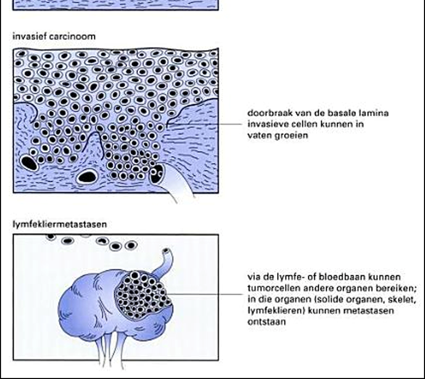 micrometastasen, dewelke zullen uitgroeien tot macroscopische tumoren. Deze laatste stap wordt kolonisatie genoemd (3).