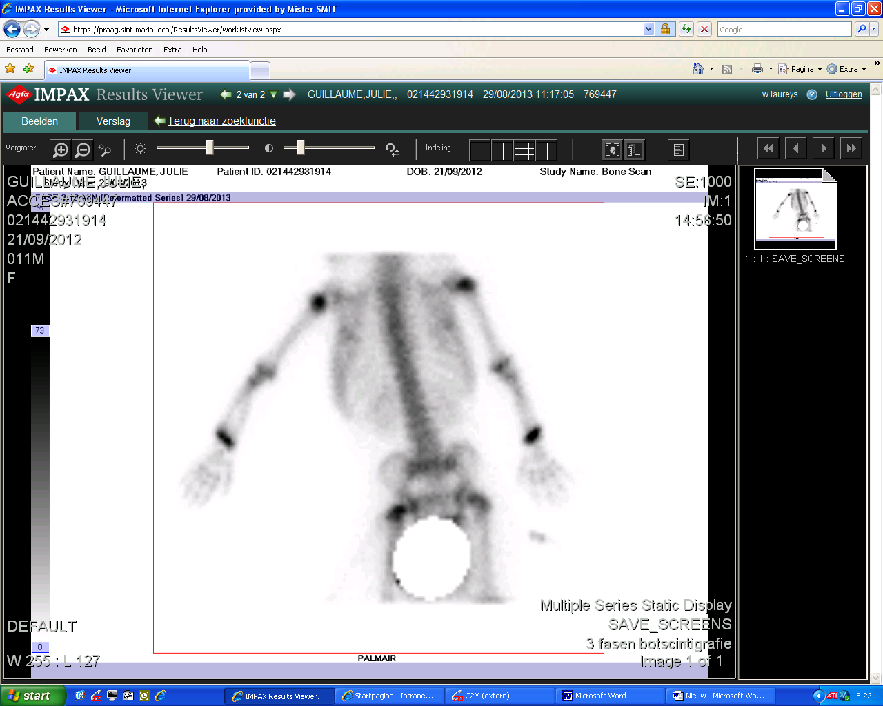 D. Botscintigrafie Aangezien negatieve RX en toch suggestieve kliniek Beperkte fissuur van de linker proximale ulna (licht