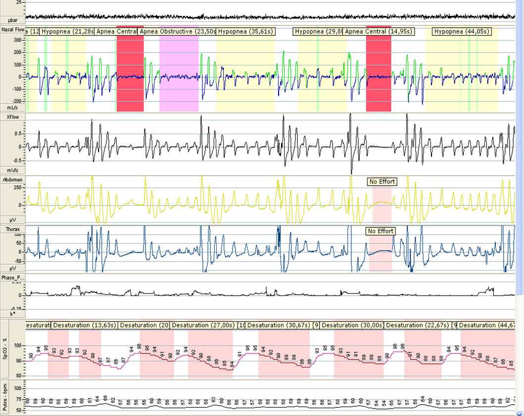 Diagnose slaapapneu Polygrafie Poly(somno)grafie Apneu-hypopneu index (AHI 15) Screening