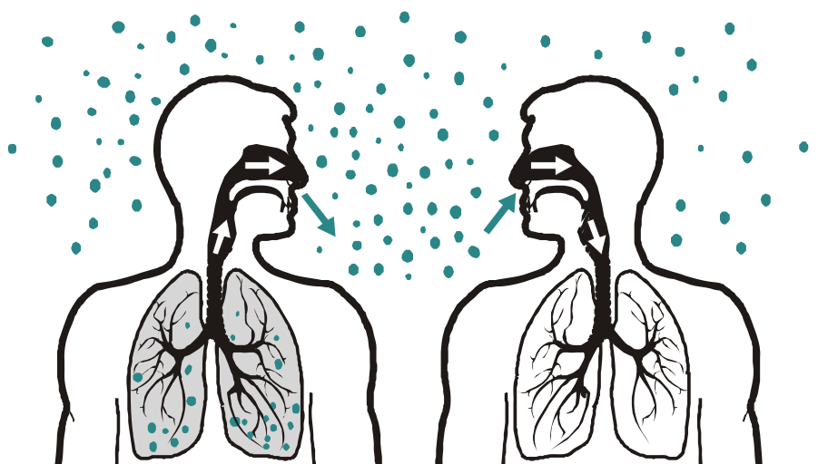 Tuberculose: natuurlijk verloop na infectie Aërogeen - droplet infectie 1 Besmettelijkheid van de TBCpatiënt 2