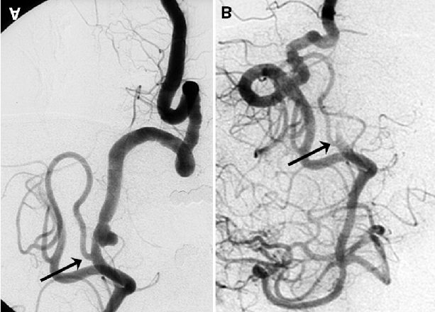 Figuur 4: Acuut geruptureerd dissectieaneurysma van de linker a. vertebralis net proximaal van de linker PICA-oorsprong bij een 47-jarige man. A: Angiogram van de linker a.