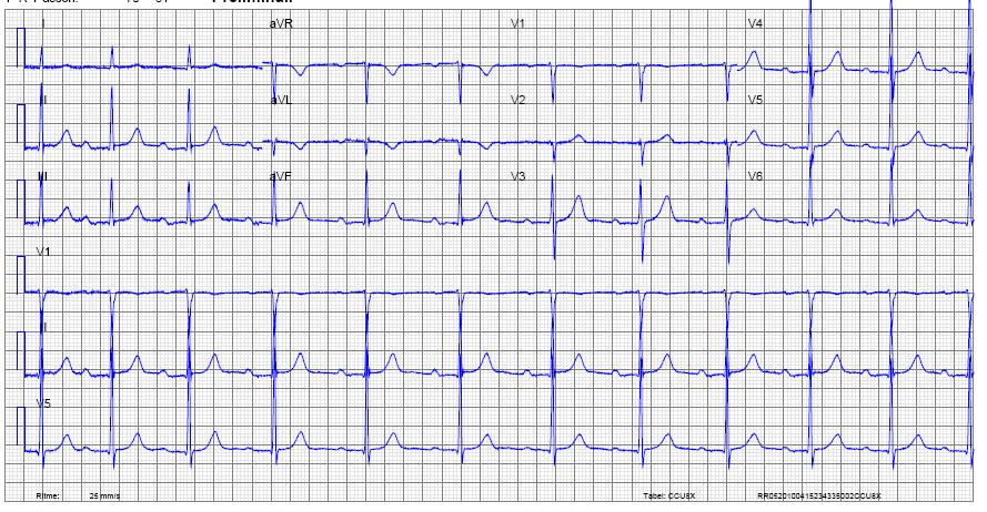 Casus 4 - ECG