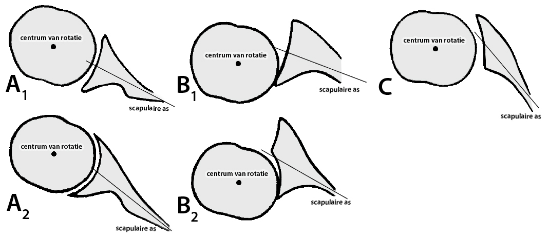 Figuur 1: Tweedimensionale classificatie van het artrotische glenoid op basis van axiale CT-beelden. Er wordt een onderscheid gemaakt tussen type A 1, A 2, B 1, B 2 en C (3).