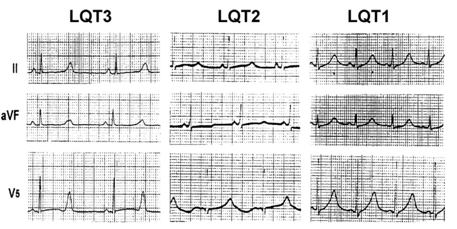 Congenitale lange-qt syndroom