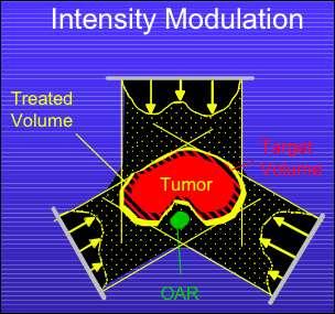 verschillende richtingen Aanpassing bundel aan contour tumor