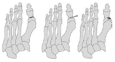 Patiënten hebben relatief weinig last van het vastgezette gewricht en kunnen hun voet weer krachtiger afzetten als vóór de operatie.