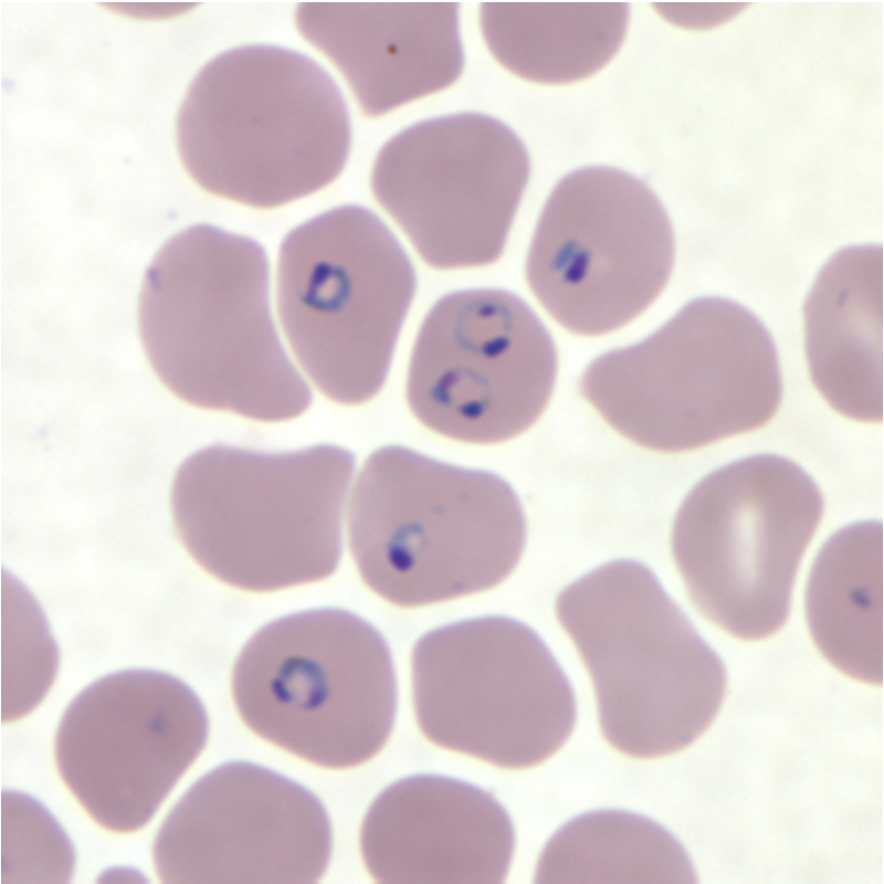 Plasmodium falciparum malaria Sequestratie in de placenta Anemie bij moeder Laag
