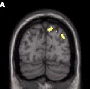 Combinatie fmri-erp/meg fmri ERP EEG: slechte localisatie maar temporeel goed fmri: spatiaal goed maar temporeel niet goed (kan