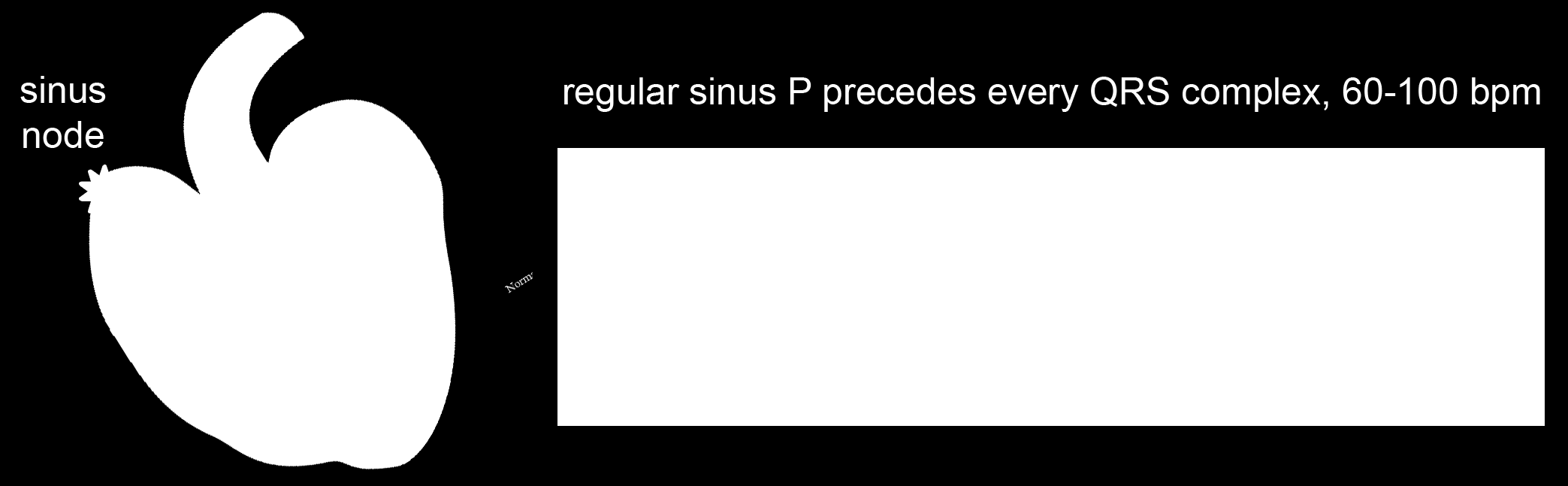 Sinus ritme Sinusritme - ritme vanuit