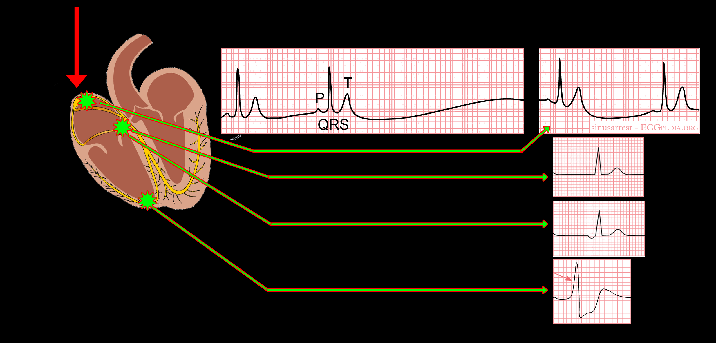 Sinus pauze / arrest Noem duur! (sec) en eventuele symptomen (duizeligheid / collaps?