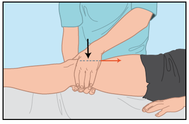 Specifieke testen Clarke sign De Clarke sign is vergelijkbaar met de Rabot-test en een van de klinisch meest gebruikte tests.