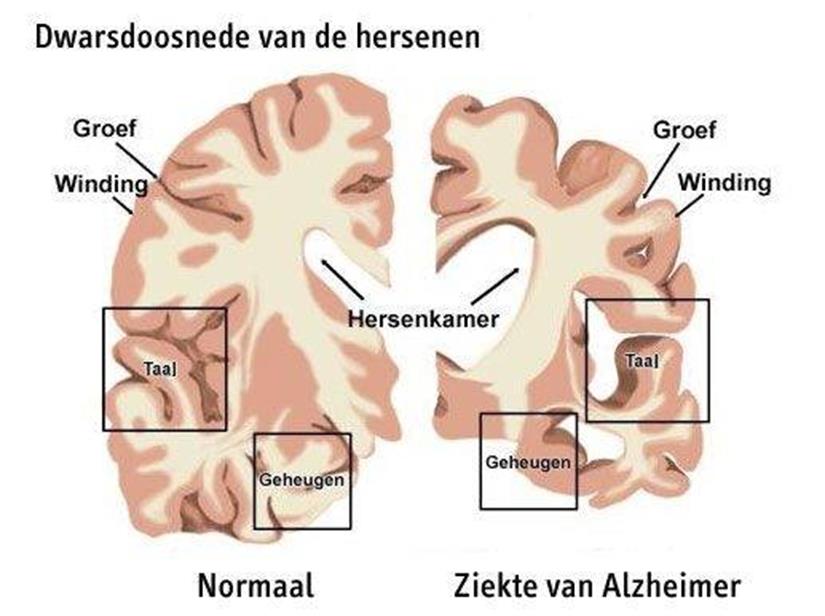 Wat is het verschil tussen dementie en Alzheimer? Dementie is een symptoom.