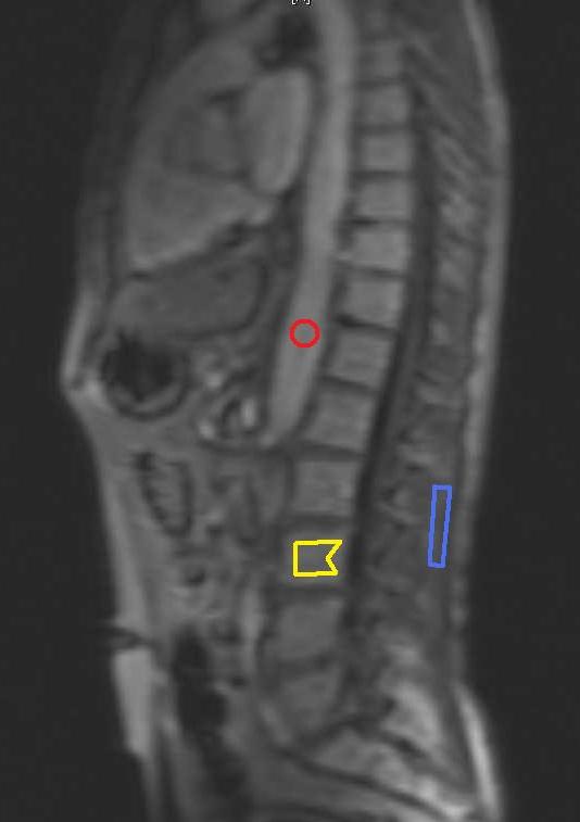 Fig.3 Illustratie van de plaatsing van ROI s en de TIC. Rood: aorta, geel: L3, blauw: paravertebrale spier.