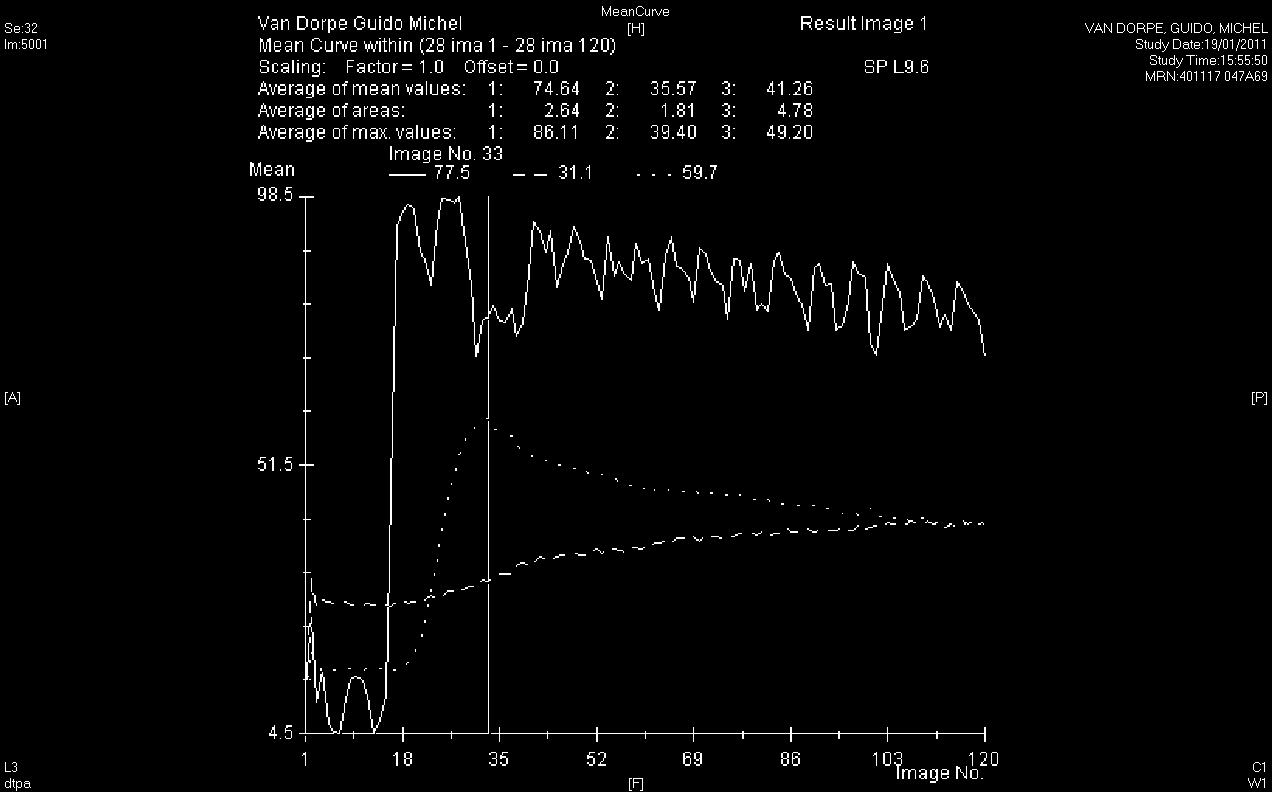 Er kon geen significante correlatie met de globale overleving worden aangetoond.